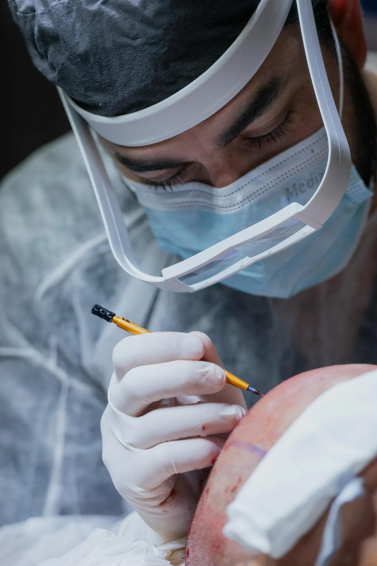 Hair Transplant